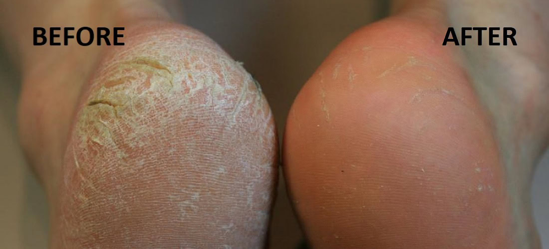 Foot callus removal before and after treatment at Clarity Health & Beauty.